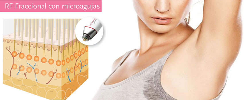 Sudoración Axilar Excesiva