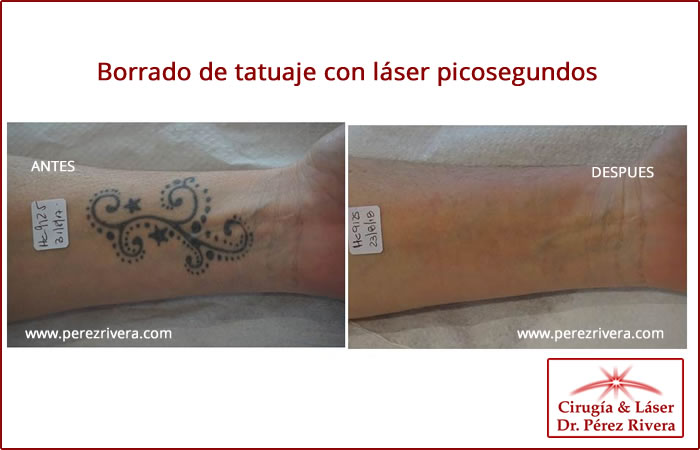 Antes y después de borrar un tatuaje