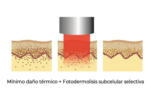 minimo daño térmico esquema