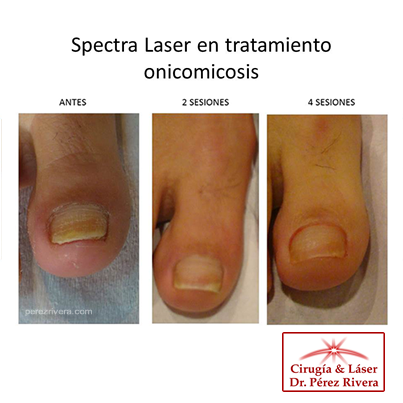 Onicomicosis. Entrevista al Dr. P�rez Rivera